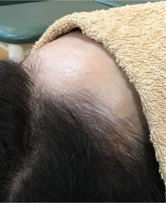 M.O.さん 9回目 ／ 生え際のボリューム改善を実感