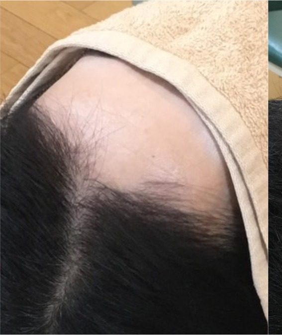 M.O.さん 1回目 ／ 生え際の薄毛が気になる状態