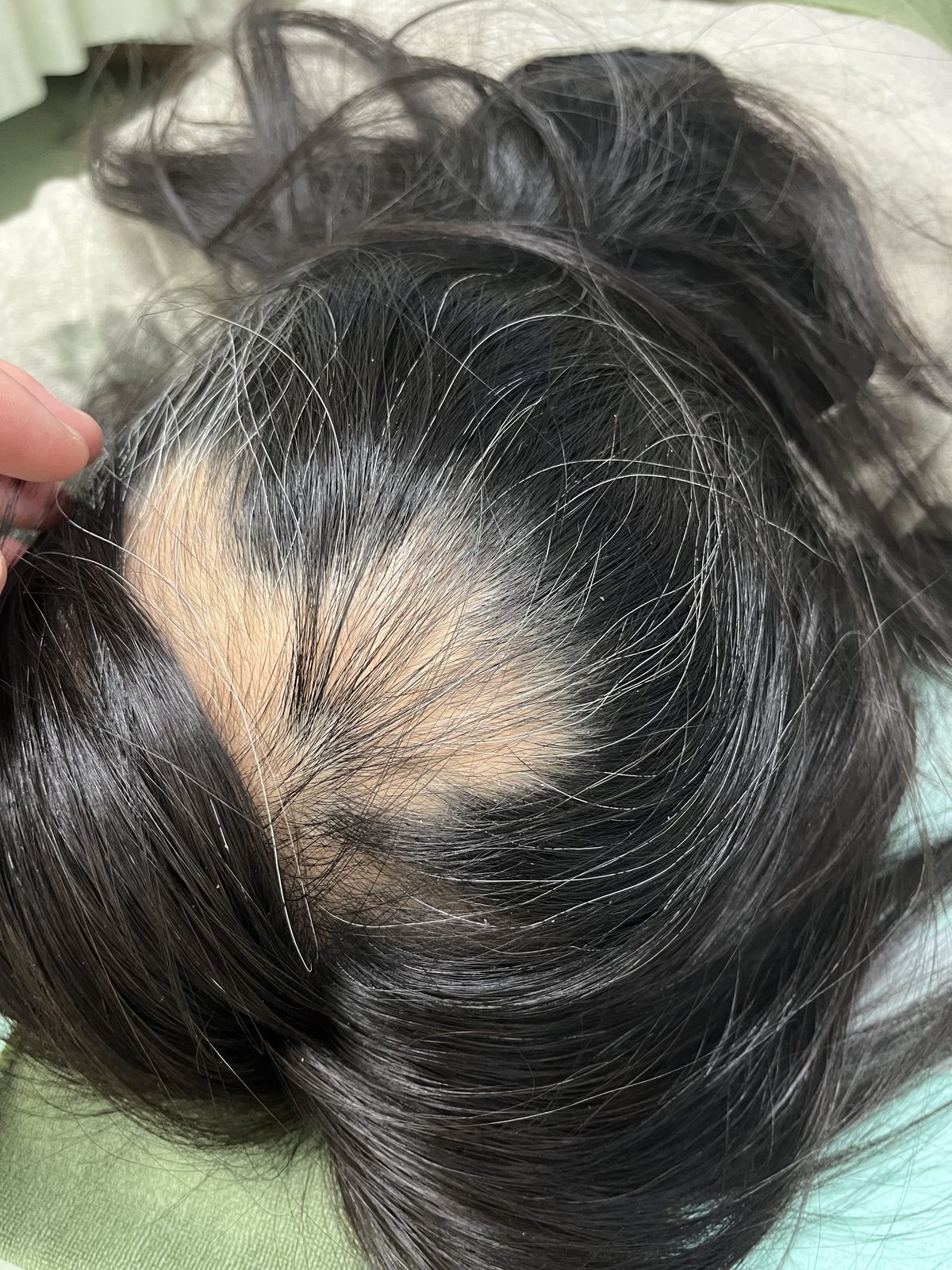 Ho.さん 6回目 ／ 頭頂部の発毛を実感