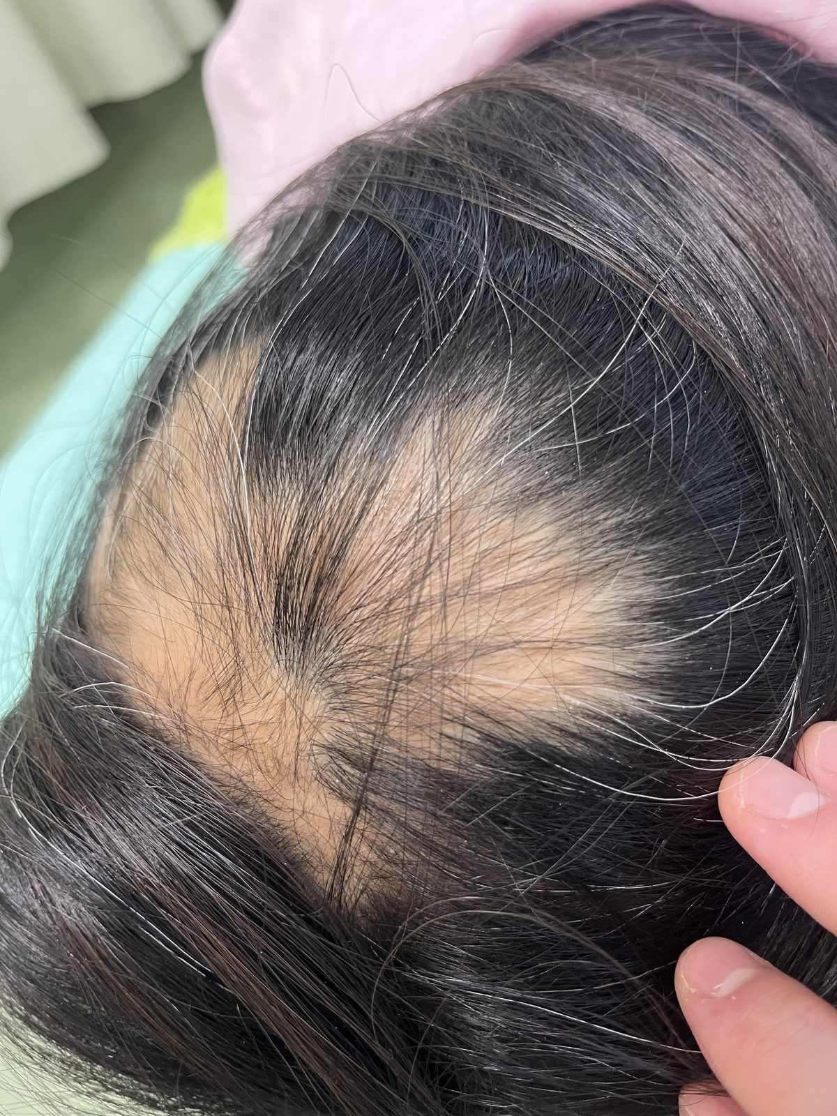 Ho.さん 1回目 ／ 頭頂部の薄毛が気になる状態