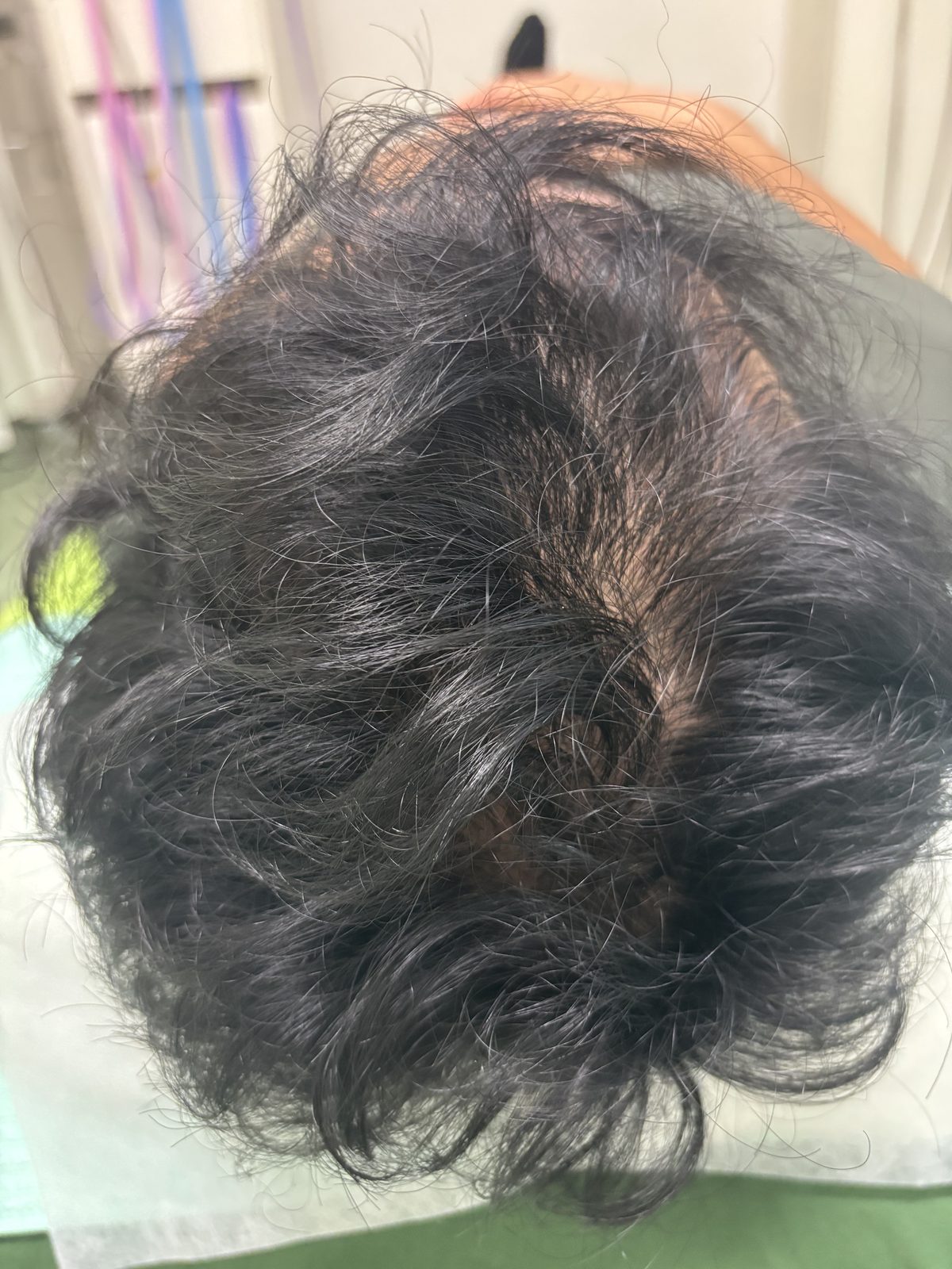Og.さん 1回目 ／ 薄毛が進行していた状態