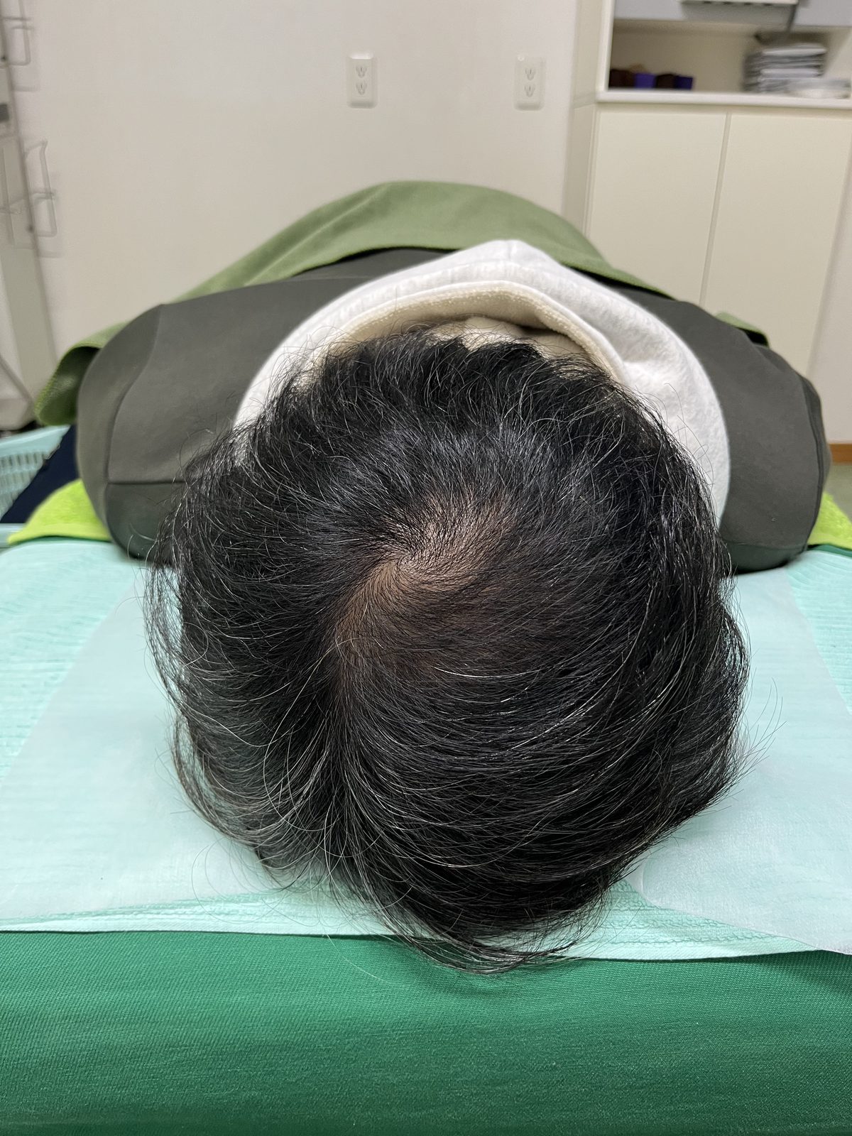 Se.さん 10回目 ／ 髪の密度改善を実感