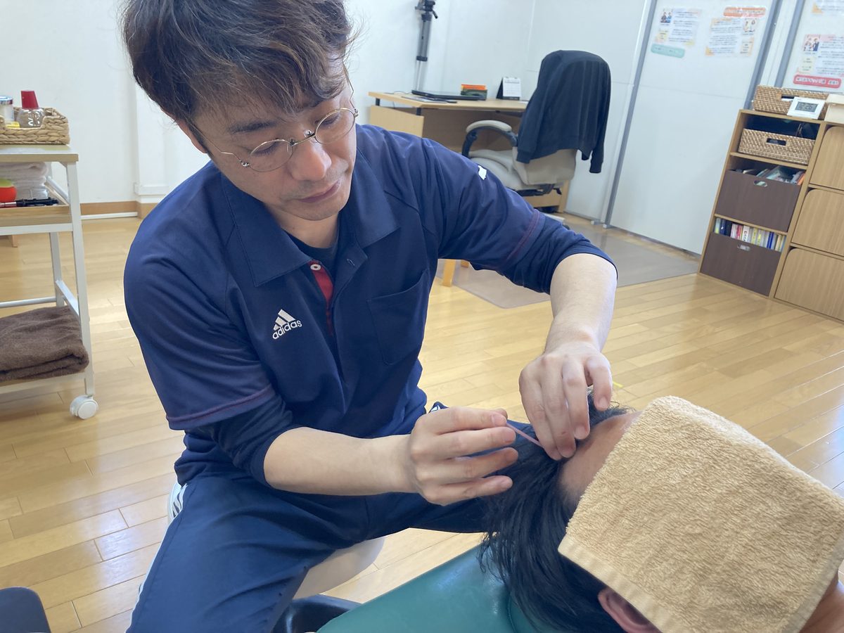 薄毛改善鍼の施術風景