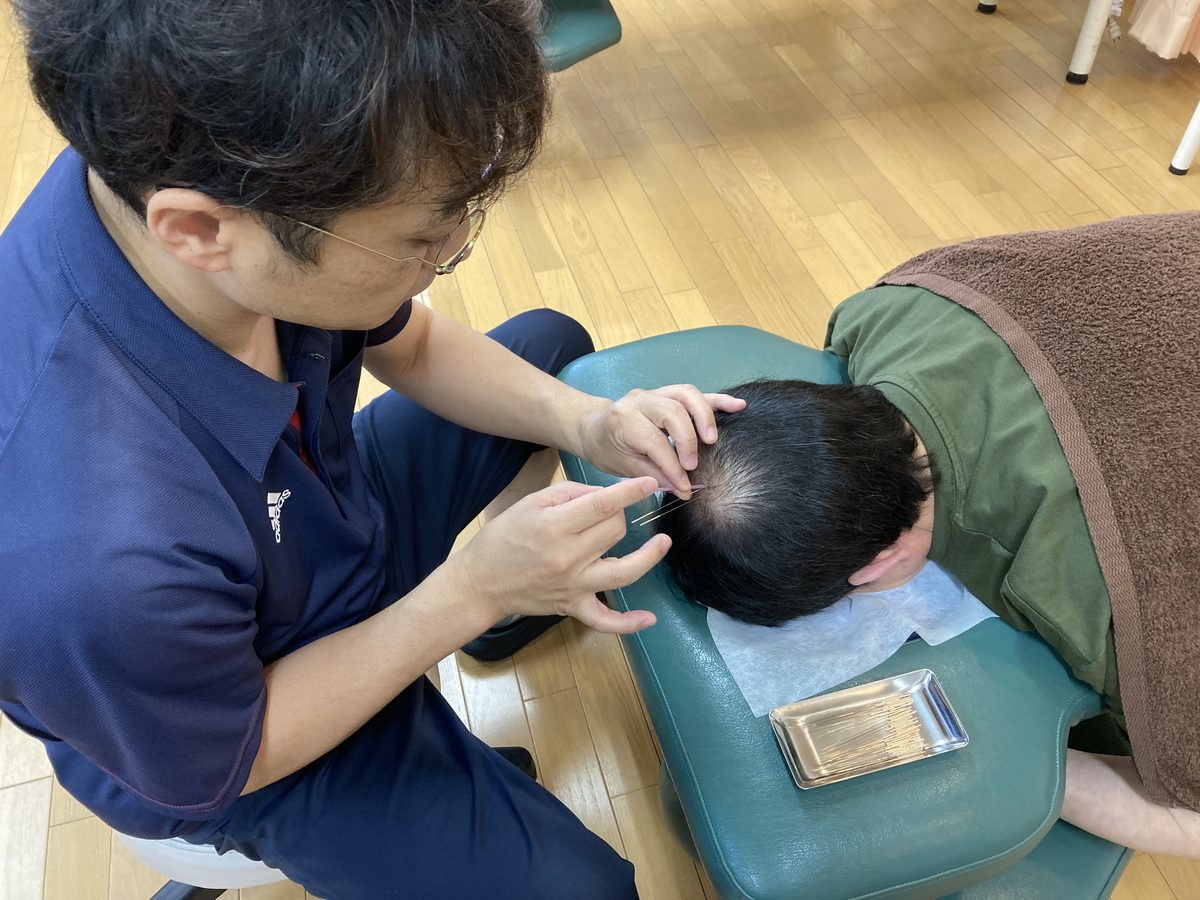 薄毛改善鍼の施術風景