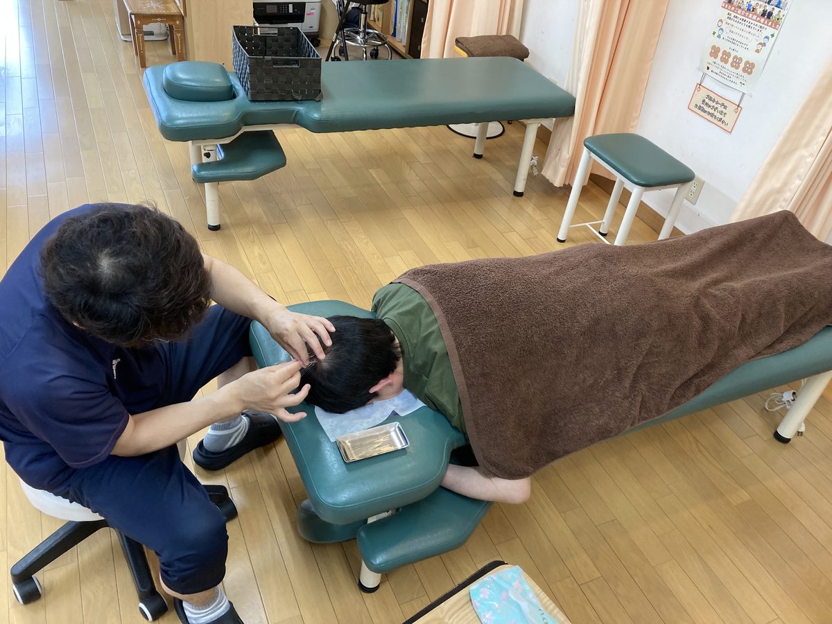 頭皮への鍼施術