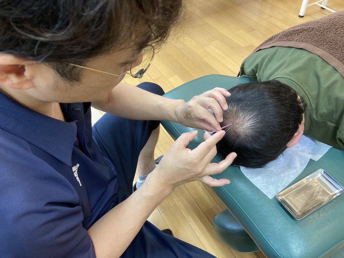 薄毛改善鍼の施術（ていねいな刺鍼の手元）