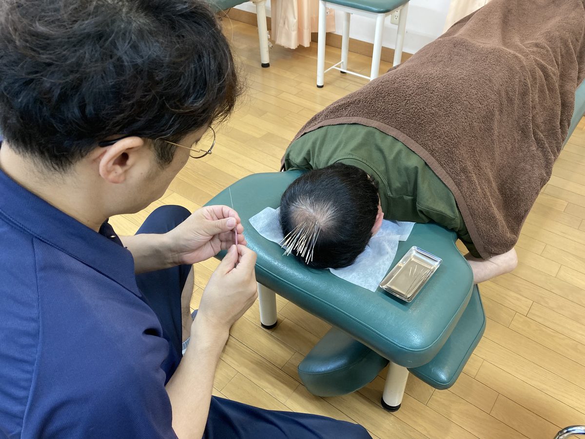 薄毛改善鍼の施術風景